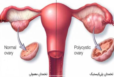 ورزش برای تقویت تخمدان زنان