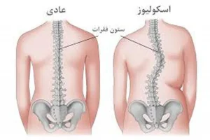 اسکولیوز ورزش برای صاف شدن ستون فقرات