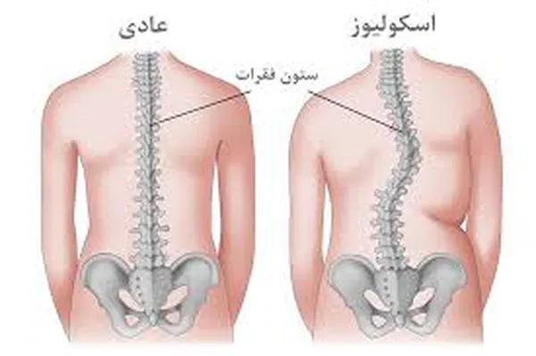 اسکولیوز ورزش برای صاف شدن ستون فقرات