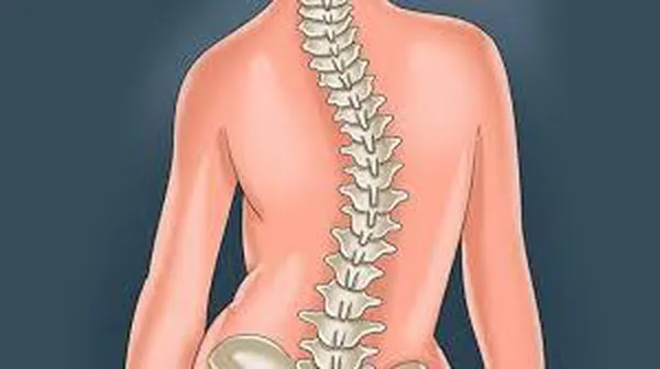 ورزش اسکولیوز ستون فقرات