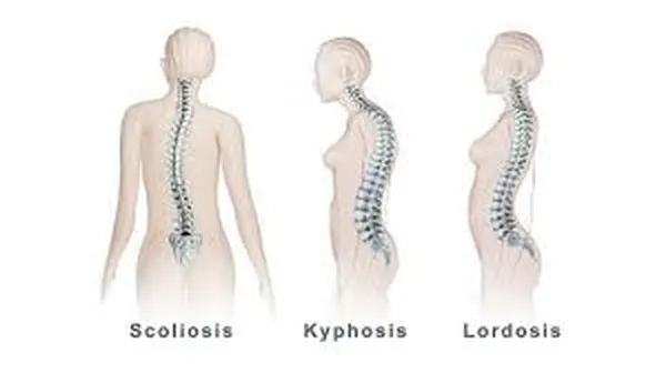 ورزش های مناسب برای انحراف ستون فقرات