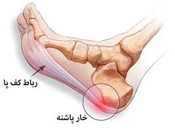 ورزش های اصلاحی خار پاشنه