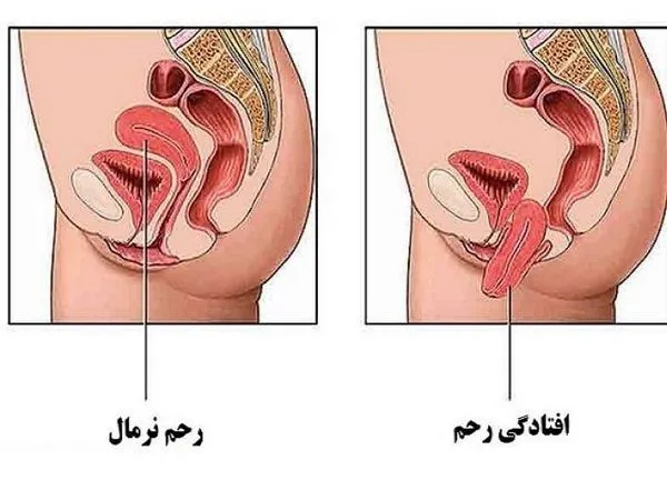 ورزش افتادگی رحم و مثانه